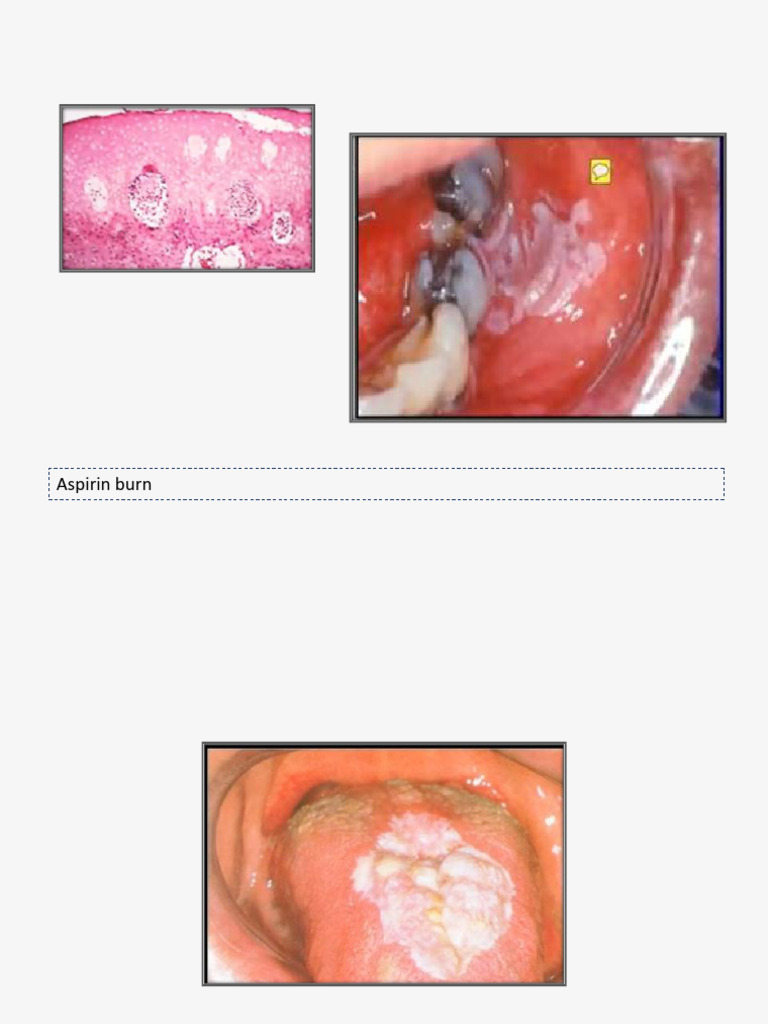 Aspirin Burn PDF
