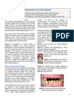 Consensus On Root Caries
