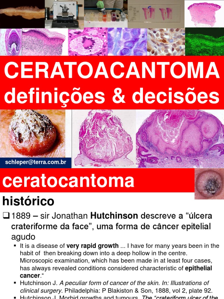 CERATOACANTOMA Outubro 2011 | PDF | Carcinoma | Câncer