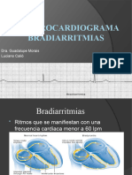 Electrocardiograma Bradiarritmia 2022