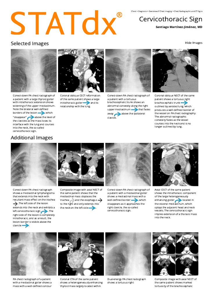 Cervicothoracic Sign - Print Friendly - STATdx | PDF | Thorax | Radiography