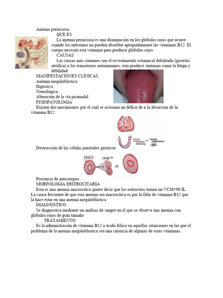 Anemia Perniciosa PDF Anemia Vitamina B12