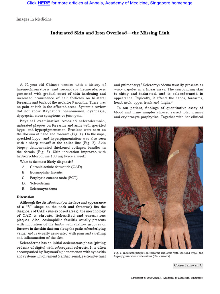 PCT Indurated Skin Iron Overload | PDF