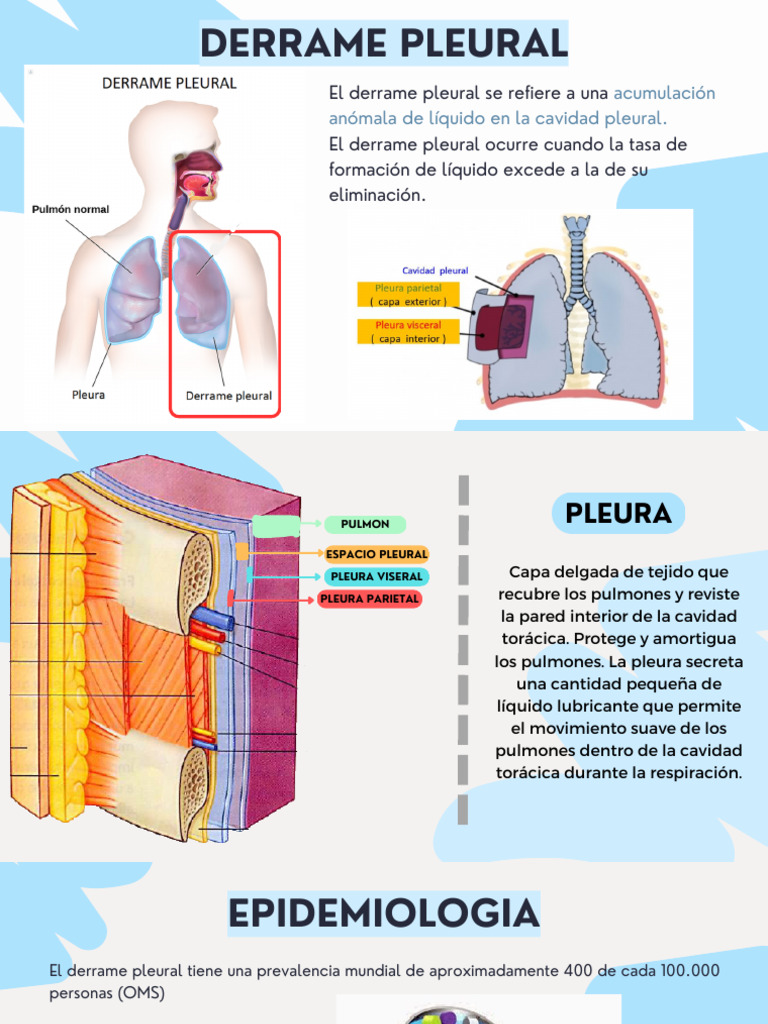 Derrame Pleural | PDF