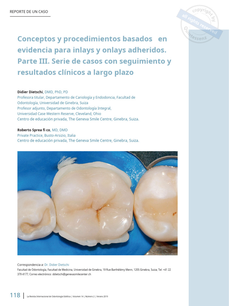 Resultados de Inlays y Onlays Dentales | PDF | Compuesto Dental ...