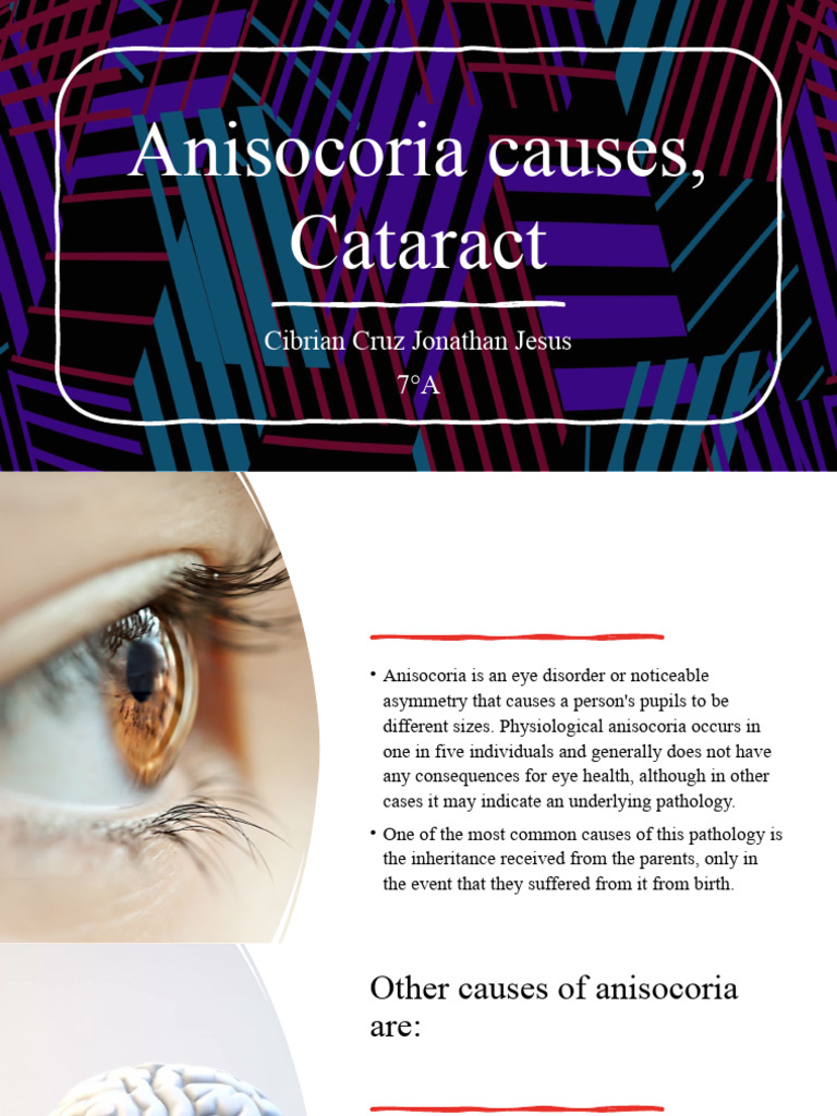 Anisocoria Causes, Cataract PDF