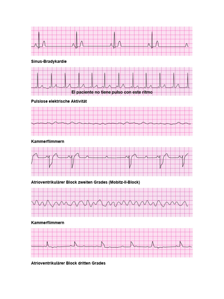 Acls Ekg | PDF