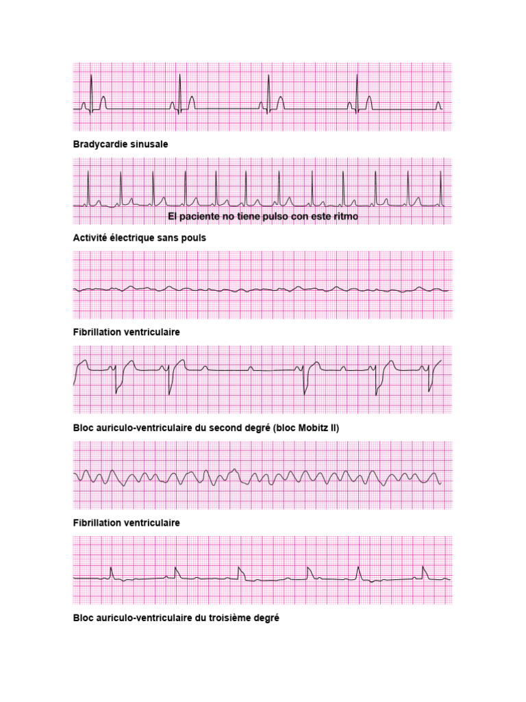 Activité Électrique Sans Pouls et Bloc AV | PDF | Médecine clinique ...