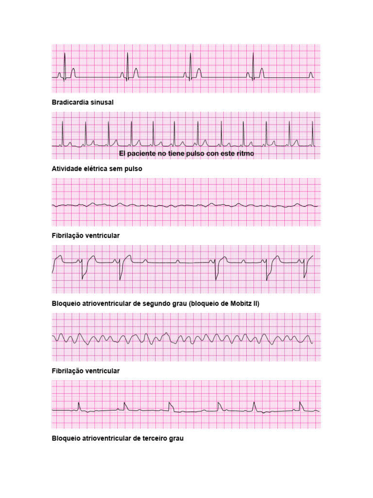 Ritmos Cardíacos e Emergências ACLS | PDF