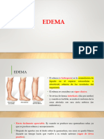 Edema