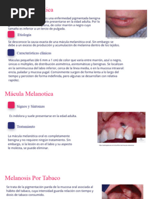 la mcula melantica oral Oral: Causas y Tratamiento | PDF | Inflamacin Mcula melantica oral.