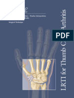 Ligament Reconstruction Tendon Interposition For Thumb CMC Arthritis