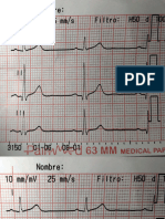 Electrocardiograma Normal