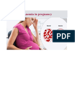 07 - New Anemia in Pregnancy