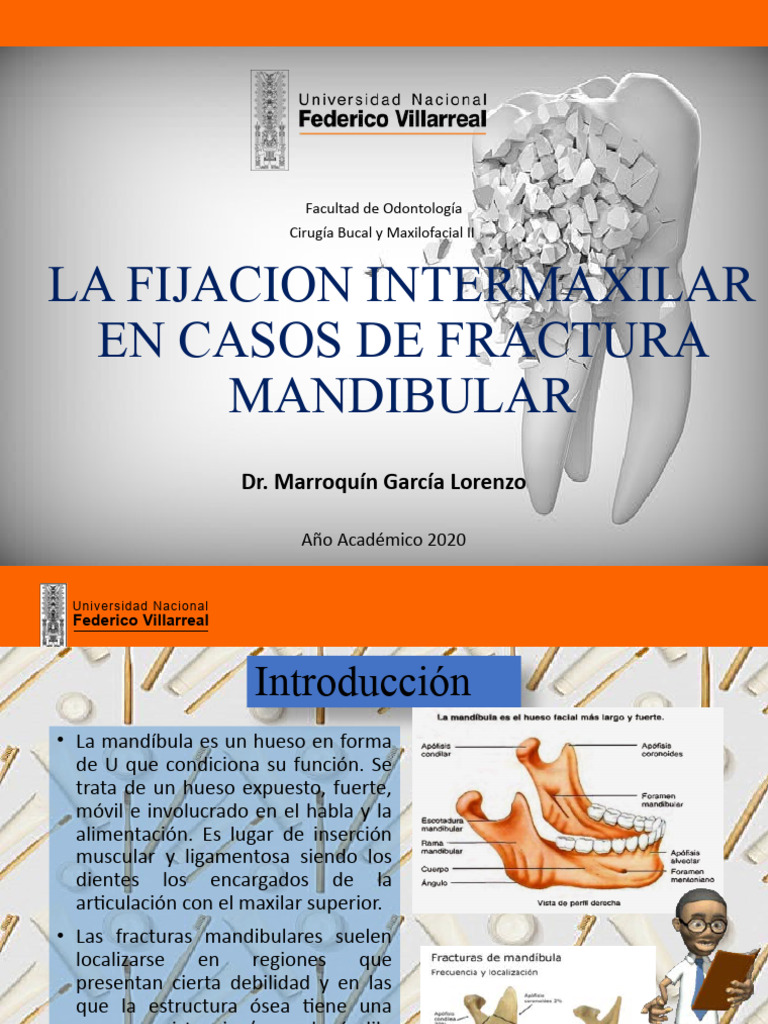Cirugia de Fractura Mandibular | PDF