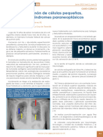 Carcinoma de Celulas Pequeñas