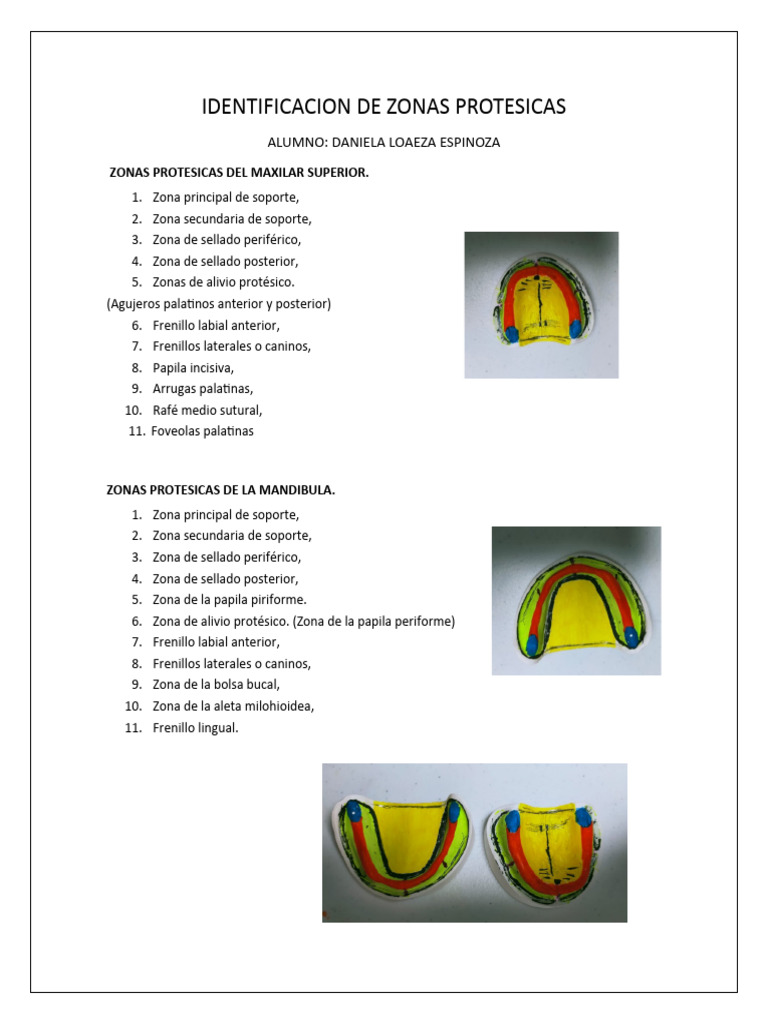 Zonas Protésicas en Maxilar y Mandíbula | PDF
