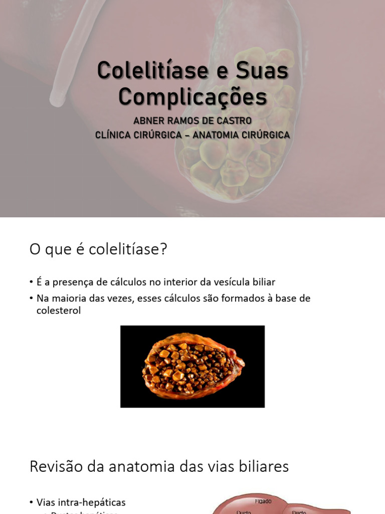 Colelitíase: Complicações e Tratamentos | PDF | Bile | Vesícula biliar