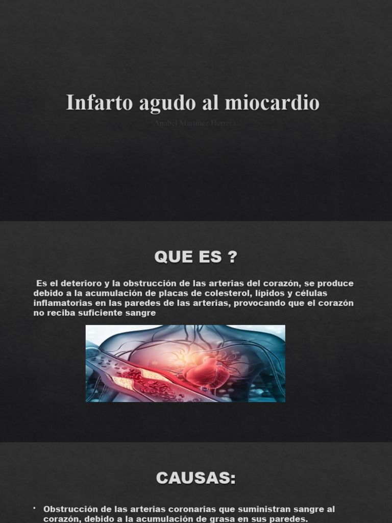 Infarto Agudo Al Miocardio | PDF | Infarto de miocardio | Corazón