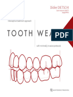 Tooth Wear