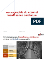 Radiographie Standard de L'insuffisance Cardiaque