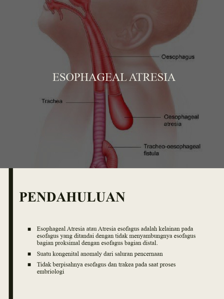 Atresia Esofagus | PDF
