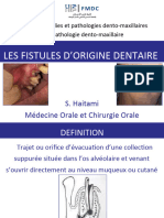 Fistules Dorigine Dentaire