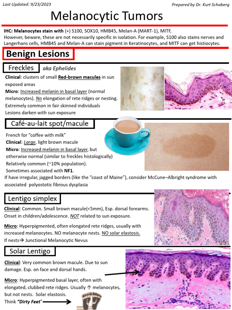 Melanocytic Tumors | PDF | Melanoma | Epidermis