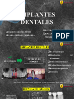 Implante Dentales