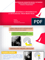 Tratamiento Ortopédico y Ortodoncico de La Hipoplasia Del Tercio Medio Facial