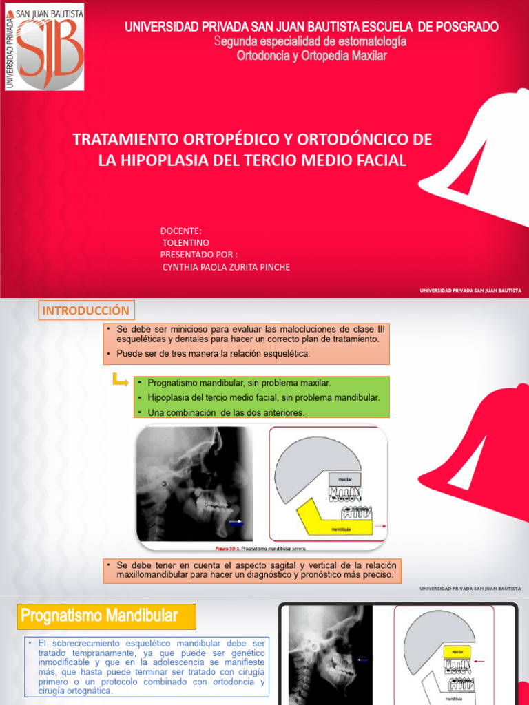 Tratamiento Ortopédico y Ortodoncico de La Hipoplasia Del Tercio Medio