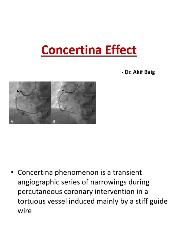 Concertina Effect PDF