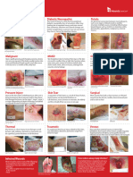 Wound Types Poster For Review