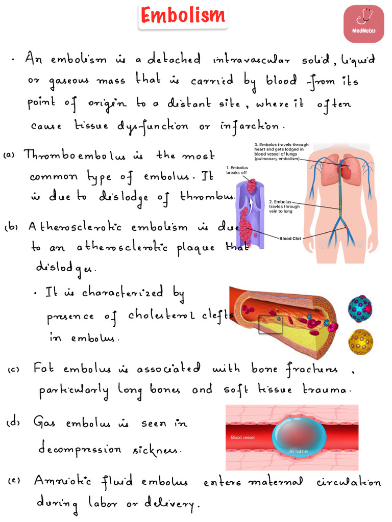 Embolism | PDF | Embolism | Thrombus