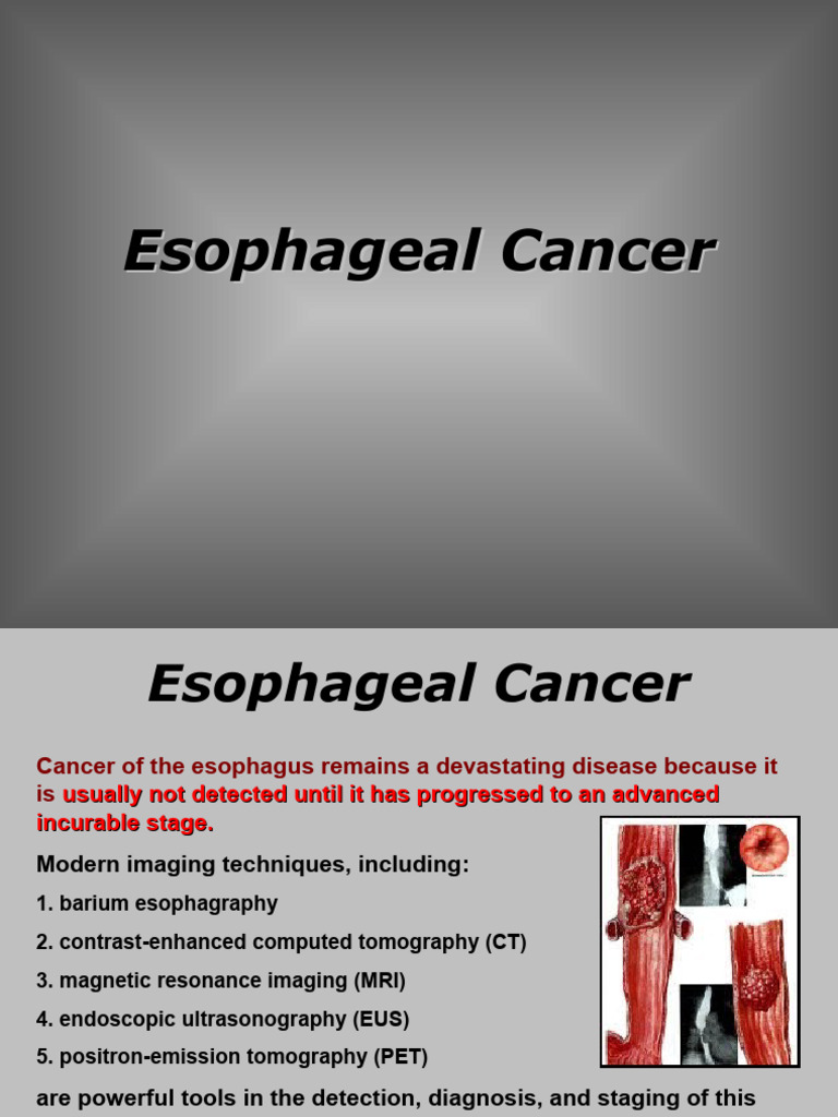 Esophageal Cancer | PDF | Esophageal Cancer | Esophagus