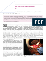 Entrapment of A Vaginal Ring Pessary - Case Report and Review of The Literature