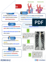 Coartación de La Aorta