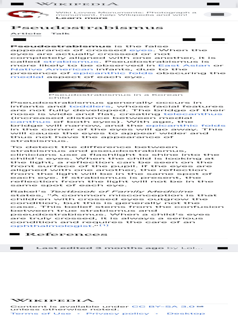 Pseudostrabismus PDF