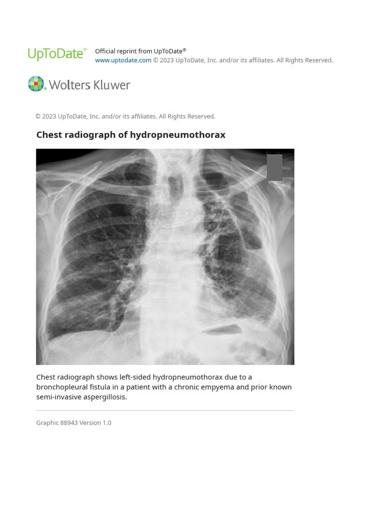 Chest Radiograph of Hydropneumothorax UpToDate PDF