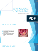 Neoplasias Malignas Cavidad Oral
