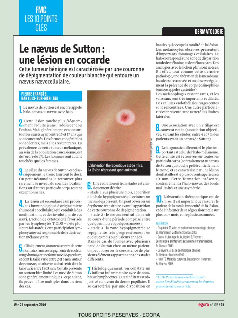 Nævus de Sutton : caractéristiques et traitement | PDF | Peau ...