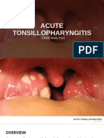 Acute Tonsillopharyngitis Case Analysis