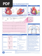 Right Ventricular Infarction - LITFL - ECG Library Diagnosis | PDF ...