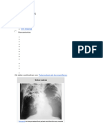 Tuberculosis