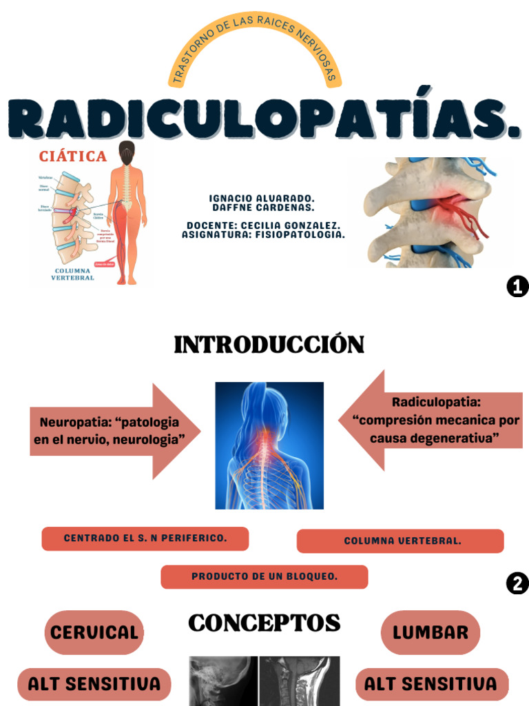 RADICULOPATIAS | PDF | Síndrome del túnel carpiano | Nervio