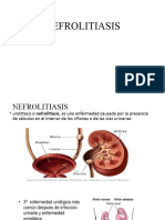 NEFROLITIASIS