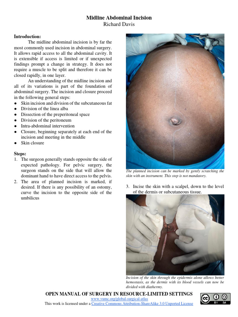 Midline Abdominal Incision Techniques | PDF | Surgical Suture | Abdomen