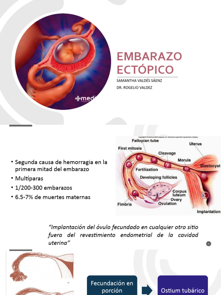 Manejo del Embarazo Ectópico | PDF | El embarazo | Ciencias de la Salud