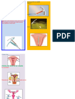 Leaflet IUD