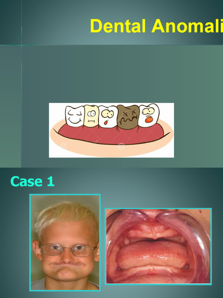 5.dental Anomalies PDF PDF Tooth Enamel Dental Anatomy
